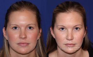  Female face, before and after rhinoplasty treatment, front view, patient 14