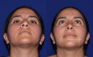  Female face, before and after rhinoplasty treatment, front view (thrown back) - patient 5
