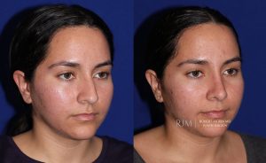  Female face, before and after rhinoplasty treatment, oblique view, patient 5