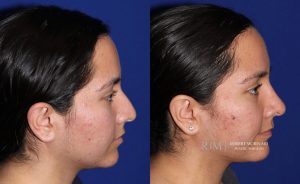  Female face, before and after rhinoplasty treatment, r-side view, patient 5