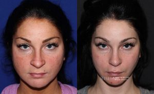  Female face, before and after rhinoplasty treatment, front view, patient 27