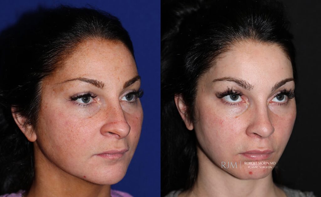  Female face, before and after rhinoplasty treatment in New Jersey, oblique view, patient 27
