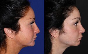  Female face, before and after rhinoplasty treatment, r-side view, patient 27