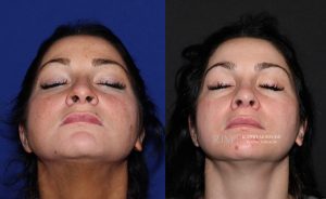  Female face, before and after rhinoplasty treatment, front view (thrown back) - patient 27