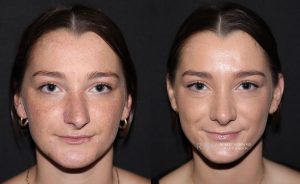 Female face, before and after rhinoplasty treatment, front view, patient 17