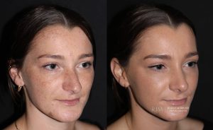  Female face, before and after rhinoplasty treatment, oblique view, patient 17