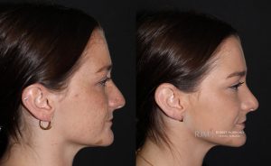  Female face, before and after rhinoplasty treatment, r-side view, patient 17
