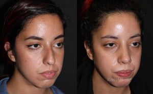  Female face, before and after rhinoplasty treatment, oblique view, patient 13