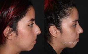  Female face, before and after rhinoplasty treatment, r-side view, patient 13