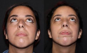  Female face, before and after rhinoplasty treatment, front view (thrown back) - patient 13