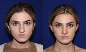  Female face, before and after rhinoplasty treatment, front view, patient 6
