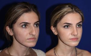  Female face, before and after rhinoplasty treatment, oblique view, patient 6