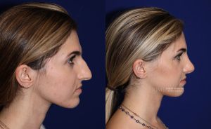  Female face, before and after rhinoplasty treatment, r-side view, patient 6