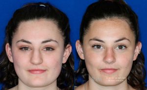  Female face, before and after rhinoplasty treatment, front view, patient 9