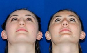  Female face, before and after rhinoplasty treatment, front view (thrown back) - patient 9