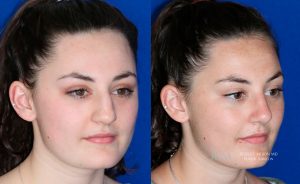  Female face, before and after rhinoplasty treatment, oblique view, patient 9
