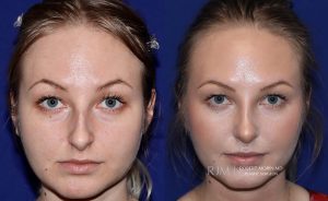  Female face, before and after rhinoplasty treatment, front view, patient 3