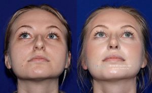 Female face, before and after rhinoplasty treatment, front view (thrown back) - patient 3