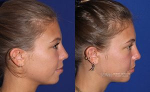  Female face, before and after rhinoplasty treatment, r-side view, patient 8
