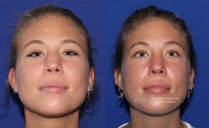  Female face, before and after rhinoplasty treatment, front view (thrown back) - patient 8