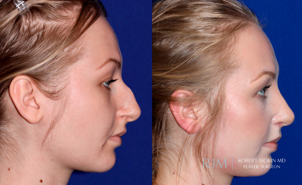 Woman's face, before and after Rhinoplasty treatment, side view, patient 1