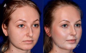 Female face, before and after rhinoplasty treatment, oblique view, patient 3