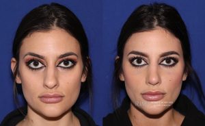  Female face, before and after rhinoplasty treatment, front view, patient 28