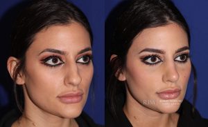  Female face, before and after rhinoplasty treatment, oblique view, patient 28