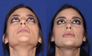  Female face, before and after rhinoplasty treatment, front view (thrown back) - patient 28