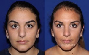  Female face, before and after rhinoplasty treatment, front view, patient 16