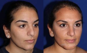  Female face, before and after rhinoplasty treatment, oblique view, patient 16