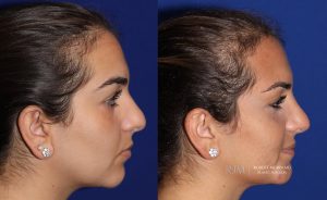  Female face, before and after rhinoplasty treatment, r-side view, patient 16