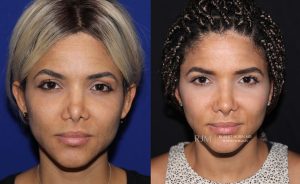  Female face, before and after rhinoplasty treatment, front view, patient 10