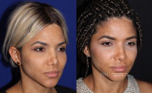  Female face, before and after rhinoplasty treatment, oblique view, patient 10