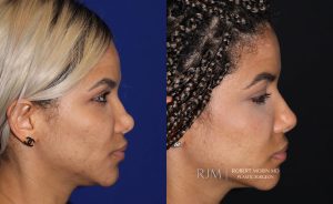  Female face, before and after rhinoplasty treatment, r-side view, patient 10