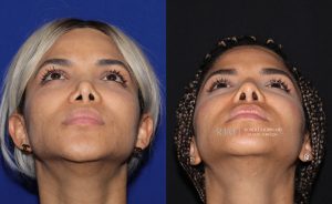  Female face, before and after rhinoplasty treatment, front view (thrown back) - patient 10