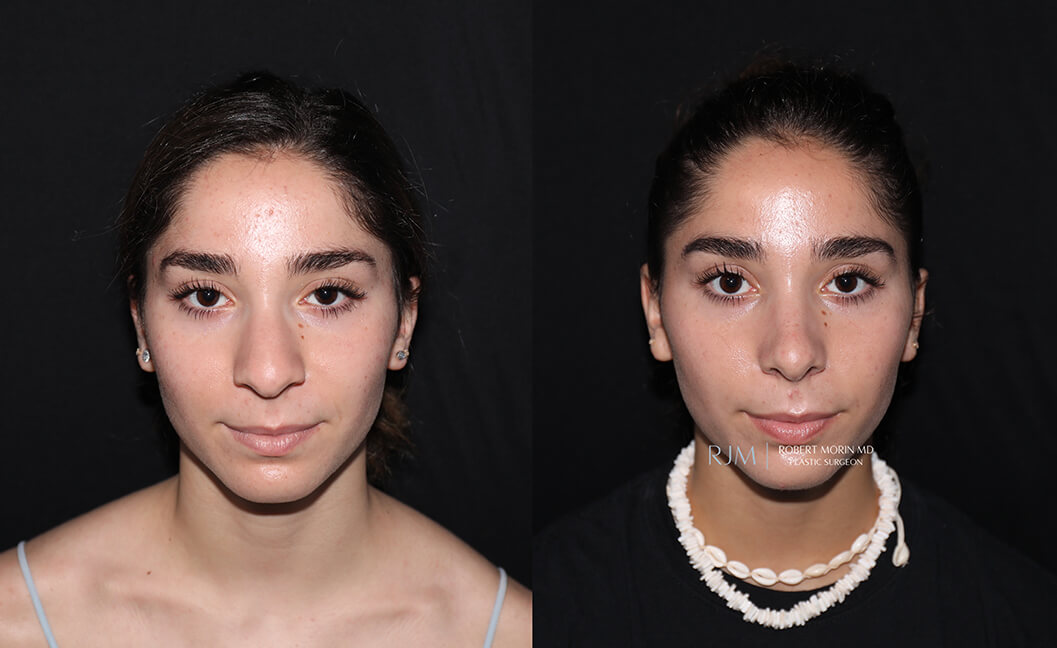 Woman's face, before and after Rhinoplasty treatment, front view, patient 5