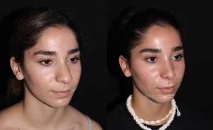  Female face, before and after rhinoplasty treatment, oblique view, patient 11