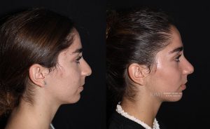  Female face, before and after rhinoplasty treatment, r-side view, patient 11