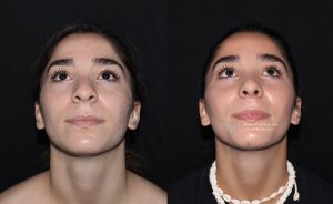  Female face, before and after rhinoplasty treatment, front view (thrown back) - patient 11