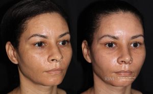  Female face, before and after rhinoplasty treatment, oblique view, patient 29