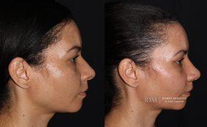  Female face, before and after rhinoplasty treatment, r-side view, patient 29