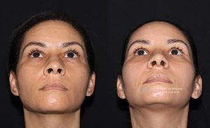  Female face, before and after rhinoplasty treatment, front view (thrown back) - patient 29