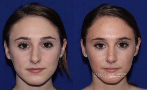  Female face, before and after rhinoplasty treatment, front view, patient 18