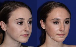  Female face, before and after rhinoplasty treatment, oblique view, patient 18