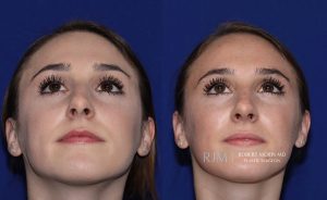  Female face, before and after rhinoplasty treatment, front view (thrown back) - patient 18