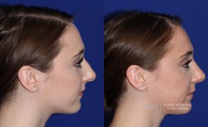  Female face, before and after rhinoplasty treatment, r-side view, patient 18