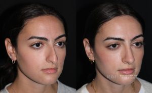  Female face, before and after rhinoplasty treatment, oblique view, patient 2