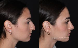  Female face, before and after rhinoplasty treatment, r-side view, patient 2