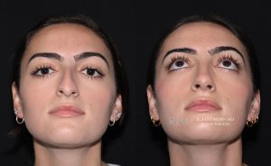  Female face, before and after rhinoplasty treatment, front view (thrown back) - patient 2